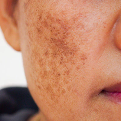 A abordagem natural que mudou a pele das minhas pacientes com MELASMA
