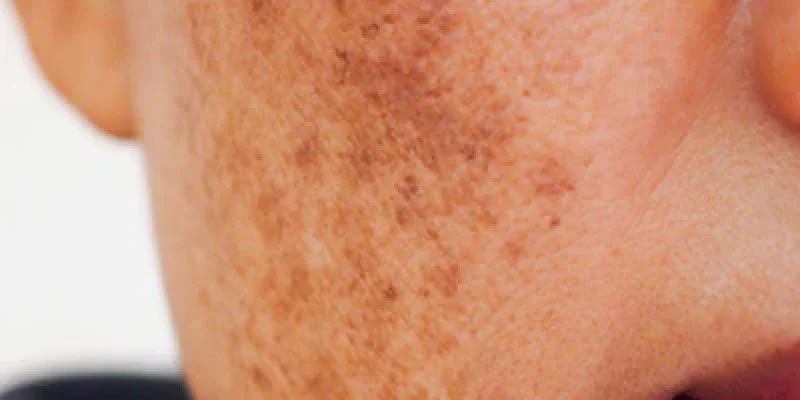 melasma_400x